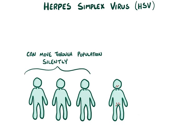 Herpes (oral genital) – causes, symptoms, diagnosis, treatment, pathology