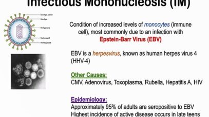 Infectious Mononucleosis (Mono) – Epstein-Barr Virus, Transmission, Symptoms, Diagnosis, Treatment