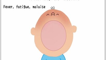 Infectious mononucleosis (Kissing disease)- Diagnosis, Clinical feature, Treatment