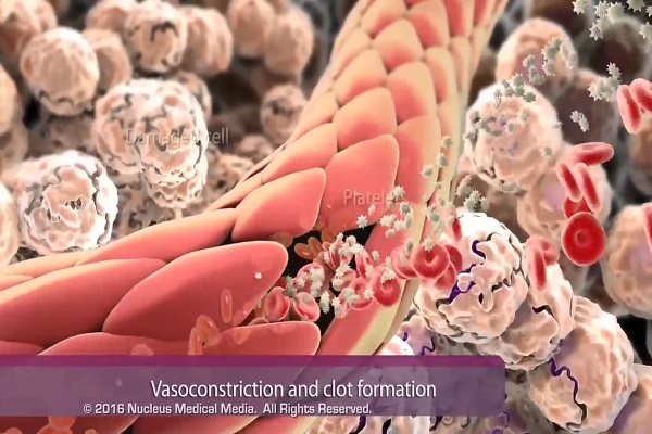 Inflammation- Immune Response to Tissue Injury or Infection