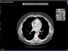 Introduction to CT Chest – Anatomy and Approach (720p60)