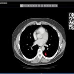 Introduction to CT Chest - Anatomy and Approach