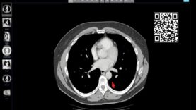 Introduction to CT Chest – Anatomy and Approach (720p60)