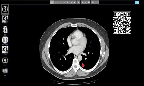 Introduction to CT Chest – Anatomy and Approach (720p60)