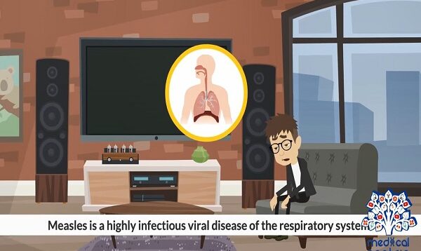 Measles, Causes, Signs and Symptoms, Diagnosis and Treatment.
