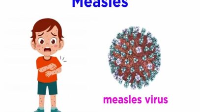 Measles (Genus Morbillivirus)
