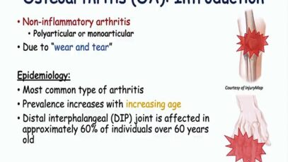 Osteoarthritis Signs Symptoms ( Why They Occur)