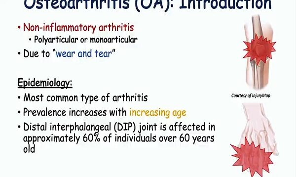Osteoarthritis Signs Symptoms ( Why They Occur)