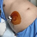 Remove abdominal fluid (ascites) - Paracentesis - Ascitic fluid aspiration