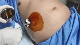 Remove abdominal fluid (ascites) – Paracentesis – Ascitic fluid aspiration
