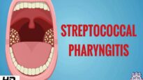 STREPTOCOCCAL PHARYNGITIS, Causes, Signs and Symptoms, Diagnosis and Treatment.