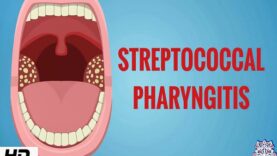 STREPTOCOCCAL PHARYNGITIS, Causes, Signs and Symptoms, Diagnosis and Treatment.