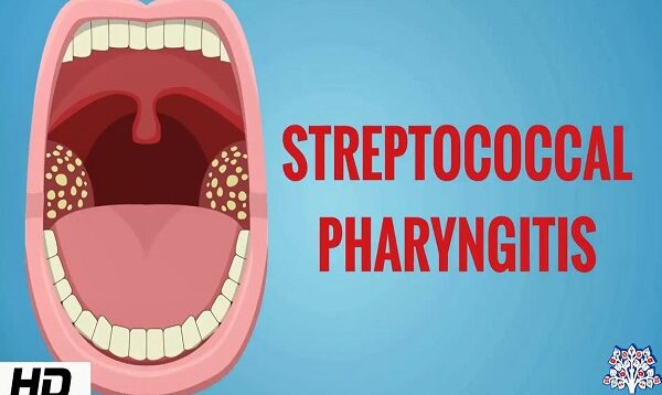 STREPTOCOCCAL PHARYNGITIS, Causes, Signs and Symptoms, Diagnosis and Treatment.