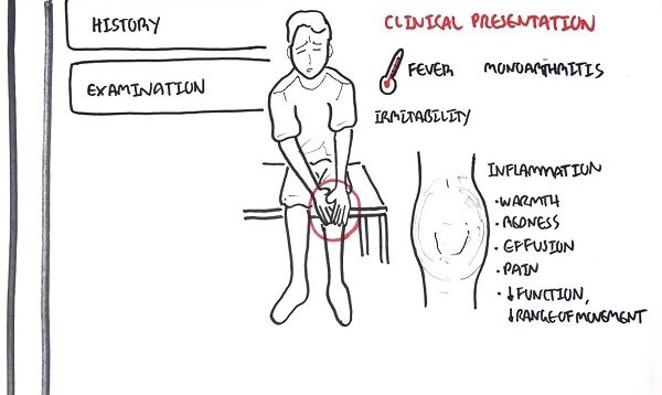 Septic Arthritis – Overview (causes, pathophysiology, treatment)