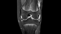 Septic arthritis of knee (joint infection).