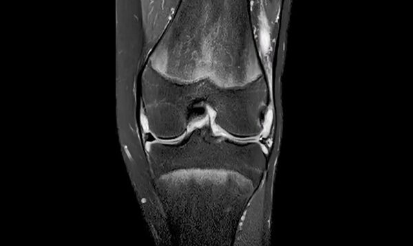Septic arthritis of knee (joint infection).