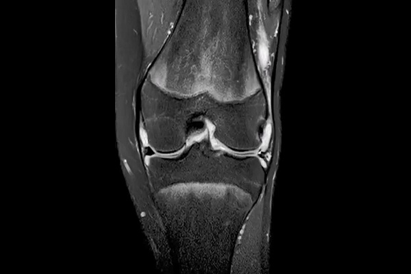 Septic arthritis of knee (joint infection).