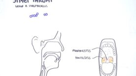 Strep throat (streptococcal pharyngitis)- pathophysciology, signs and symptoms, diagnosis, treatment