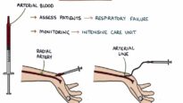 Understanding Arterial Blood Gases