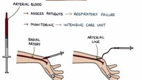 Understanding Arterial Blood Gases