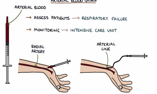 Understanding Arterial Blood Gases