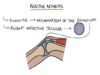 Understanding Reactive Arthritis