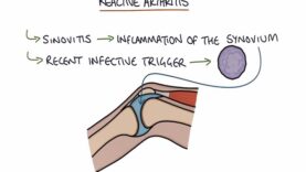 Understanding Reactive Arthritis