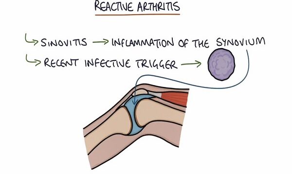 Understanding Reactive Arthritis