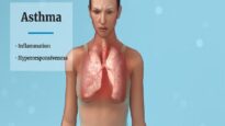 What Is Severe Asthma