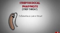 What is Streptococcal Pharyngitis. – Strep Throat Made Astoundingly Simple