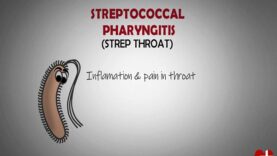 What is Streptococcal Pharyngitis. – Strep Throat Made Astoundingly Simple