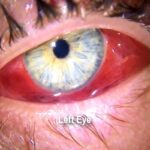 Acute hemorrhagic conjunctivitis
