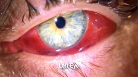 Acute hemorrhagic conjunctivitis