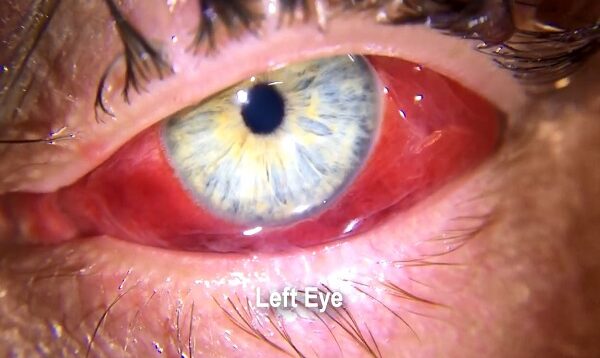 Acute hemorrhagic conjunctivitis