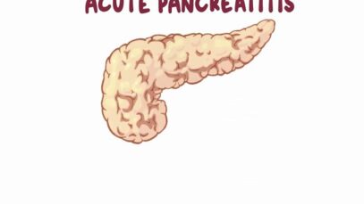 Acute pancreatitis