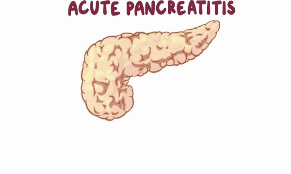 Acute pancreatitis