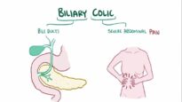 Biliary colic (gallbladder attack) – causes, symptoms, diagnosis, treatment, pathology