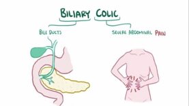 Biliary colic (gallbladder attack) – causes, symptoms, diagnosis, treatment, pathology