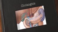 Cholangitis