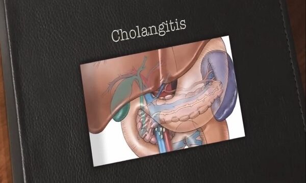 Cholangitis