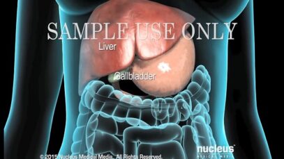 Cholecystectomy – Gallbladder Removal Surgery