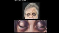 Clinical Signs of Base of Skull Fracture – including Racoon eyes, Battle’s Sign more!
