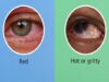 Conjunctivitis- symptoms and treatment for red, itchy, watery eyes