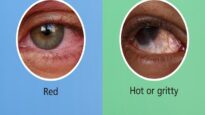 Conjunctivitis- symptoms and treatment for red, itchy, watery eyes