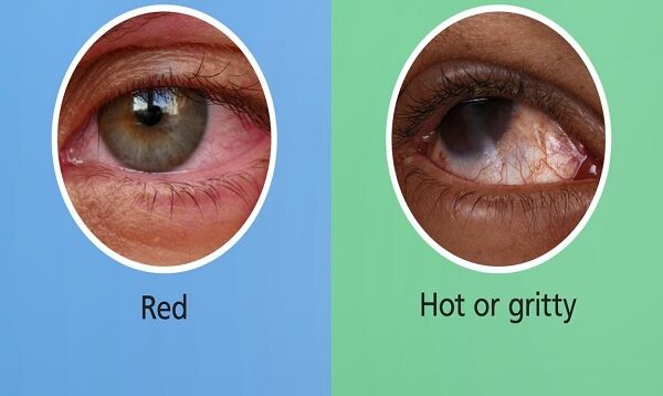 Conjunctivitis- symptoms and treatment for red, itchy, watery eyes