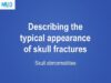 Describing the typical appearance of skull fractures as seen on computed tomography (CT) imaging
