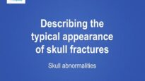 Describing the typical appearance of skull fractures as seen on computed tomography (CT) imaging