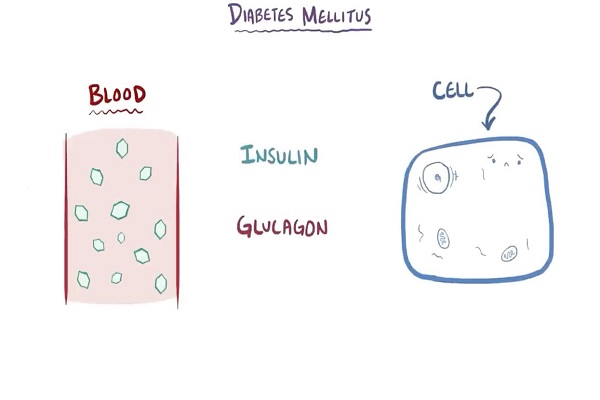 Diabetes mellitus (type 1, type 2) diabetic ketoacidosis (DKA)