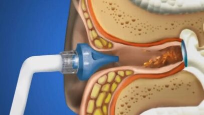 Ear Irrigation