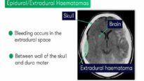 Extradural vs Subdural Haematomas – How do we Diagnose them on CT.